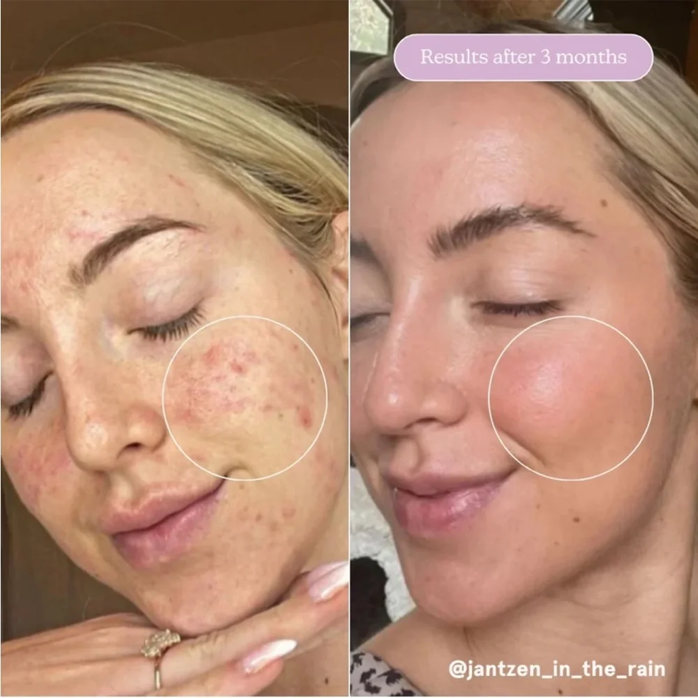 NWT 🩵 Blume Meltdown Gel Cream for Acne-Prone Skin NEW WITH BOX! - Picture 3 of 6